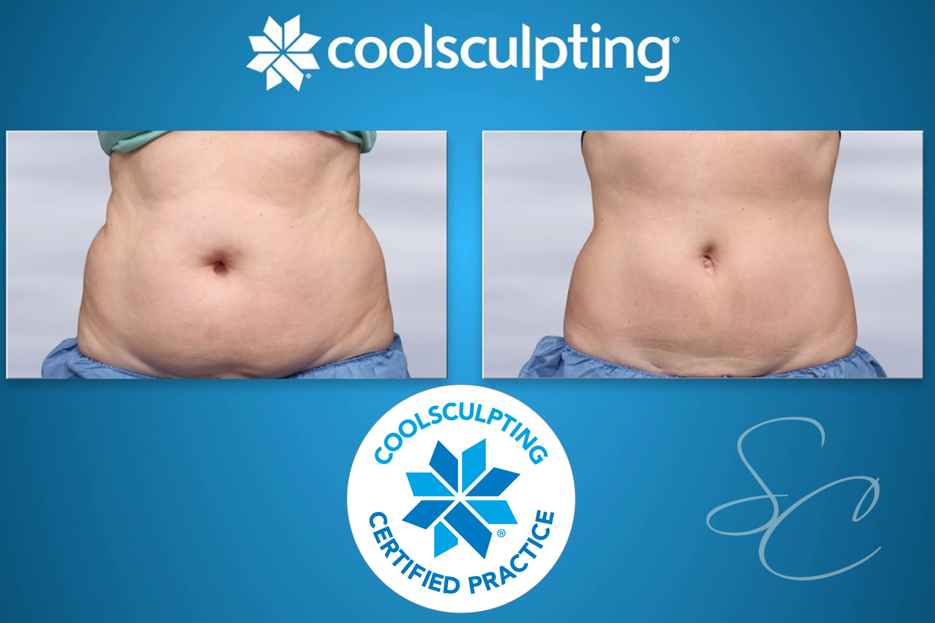 coolsculpting-southern-california-surgical-center